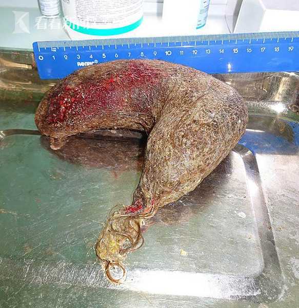 俄罗斯16岁少女肚皮鼓肿如孕妇医生手术取出11斤重“毛怪物”