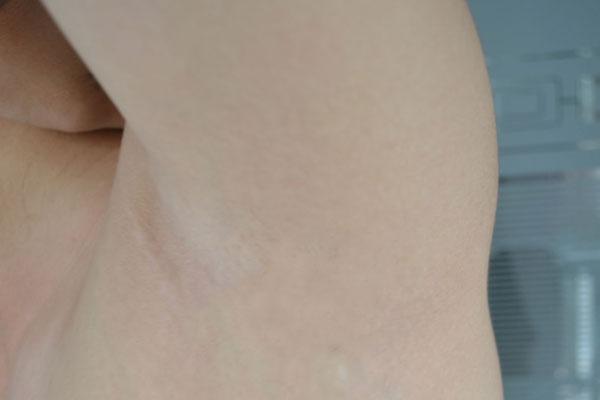 腋毛浓密的女人怎么处理,怎样有效去除腋毛的方法