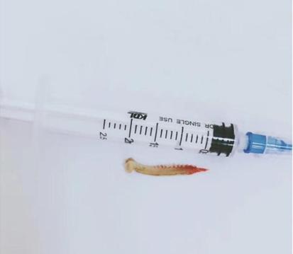 鱼刺卡喉轻松解决快1年了,鱼刺卡喉咙医院怎么处理