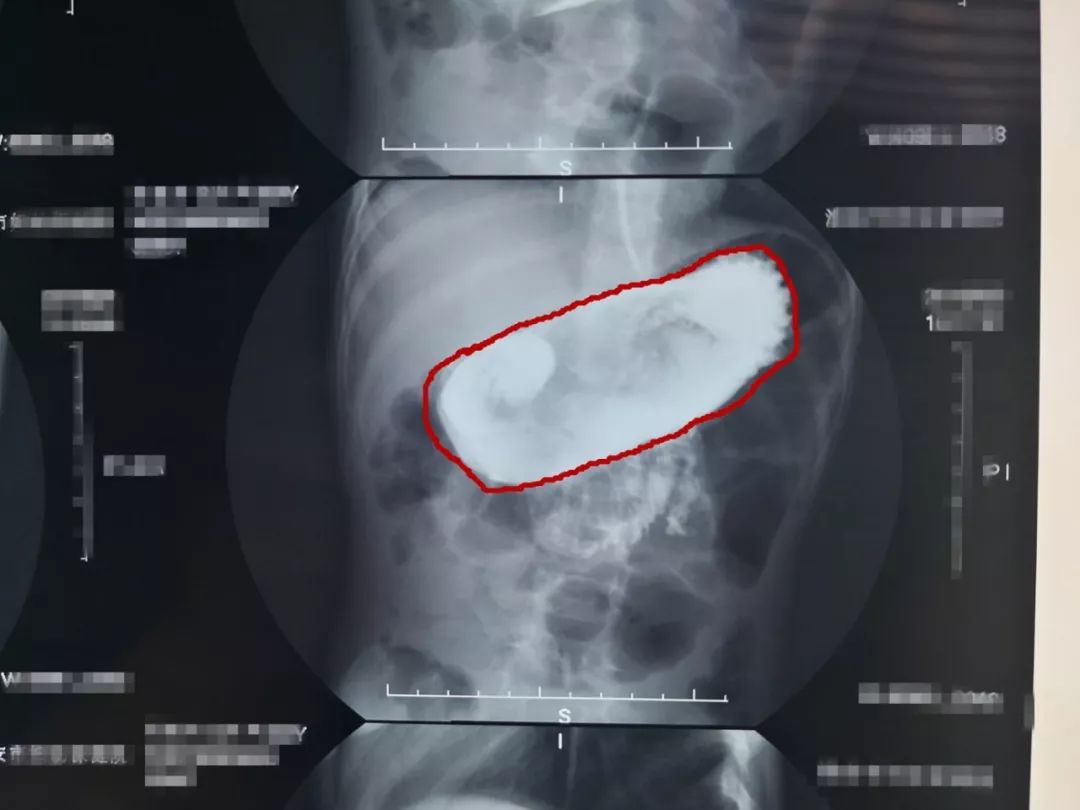 小孩吃了一根头发到肚子里怎么办,小孩子不小心吃了头发到肚子里