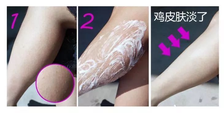 鸡皮肤永久消除,37天快速祛鸡皮肤