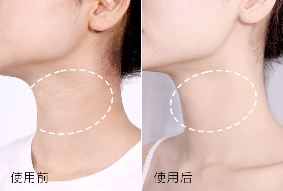 脖子长纹的女人,中年妇女脖子有几圈纹是怎么来的