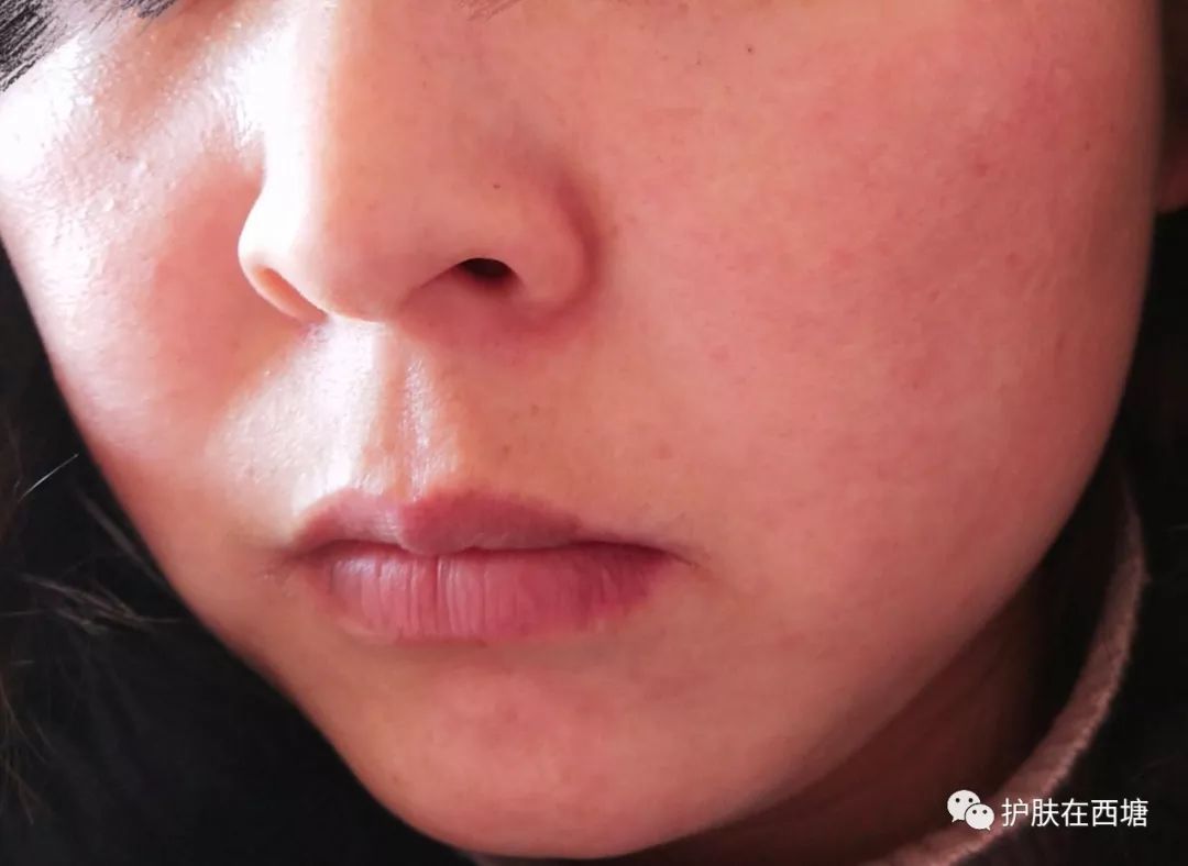 关于皮肤皮炎的几种症状,面部皮炎中医诊断名称