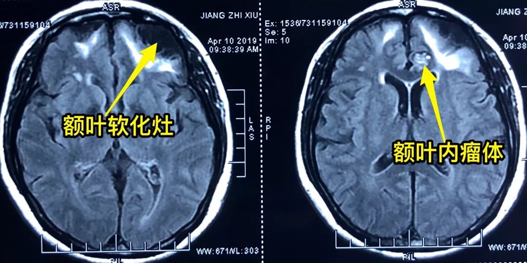 头痛医生说脑子长东西了,头疼头晕是脑袋里长什么东西了