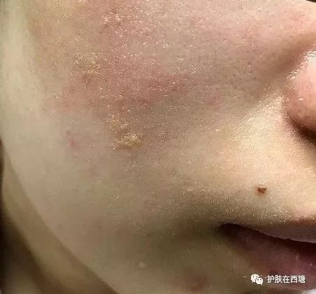 他克莫司软膏治疗脂溢性皮炎,面部皮肤脂溢性皮炎治疗方法