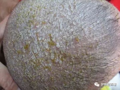 常见面部皮肤病,三脂溢性皮炎