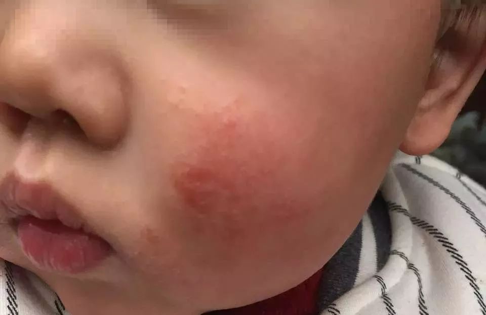 常见面部皮肤病,三脂溢性皮炎