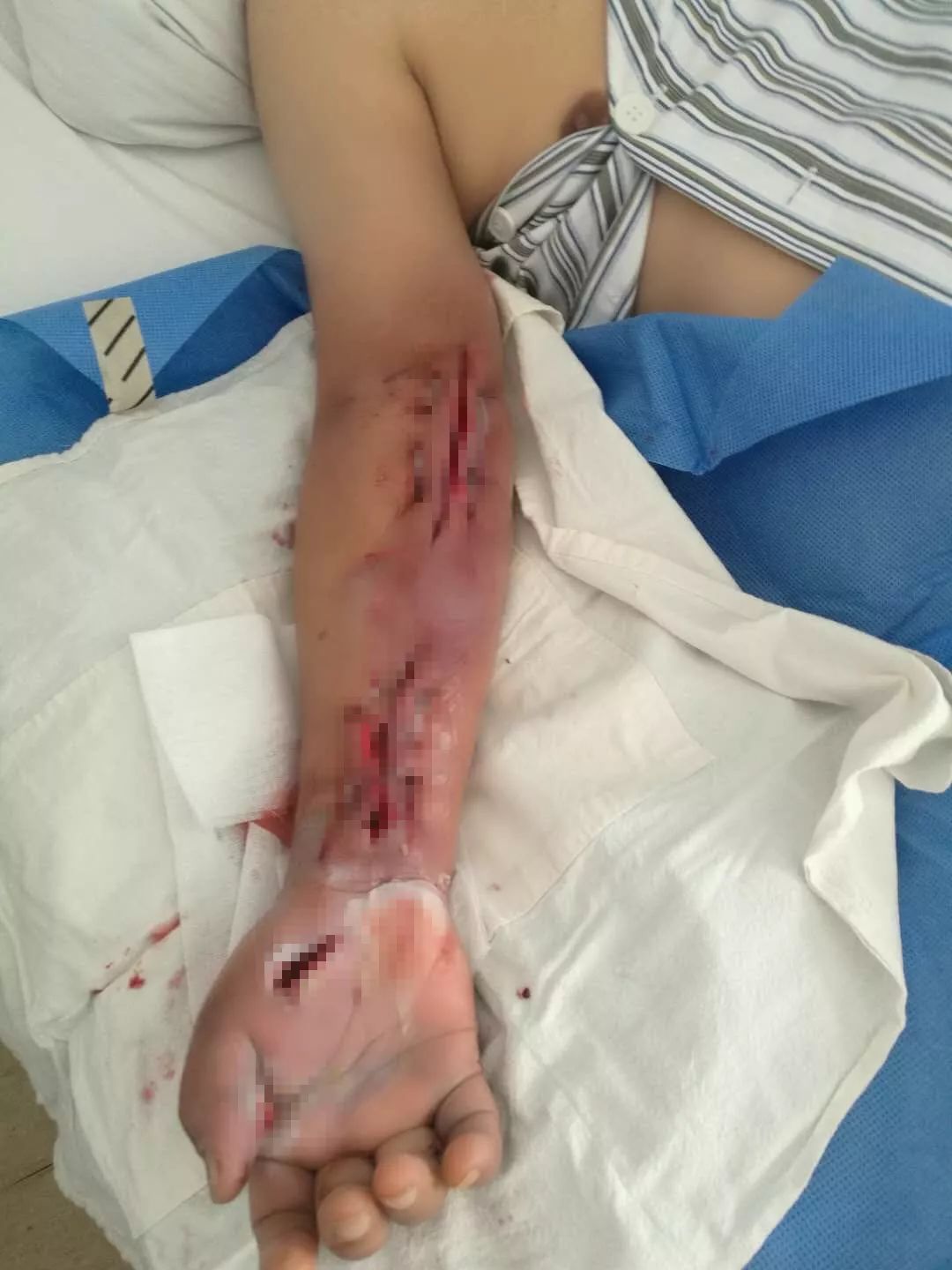 被虾刺破手了会导致什么病,被大虾刺破手指有危险吗