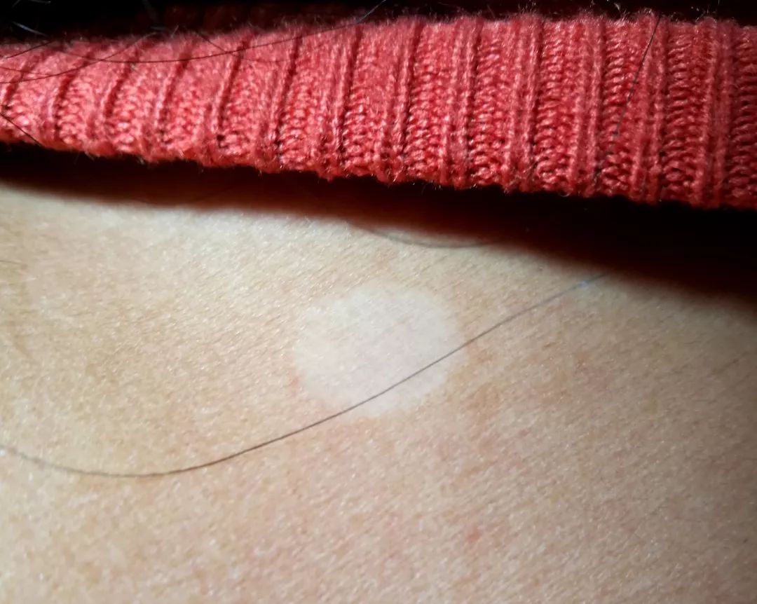 白色花斑糠疹,白色糠疹需要与哪些疾病相鉴别