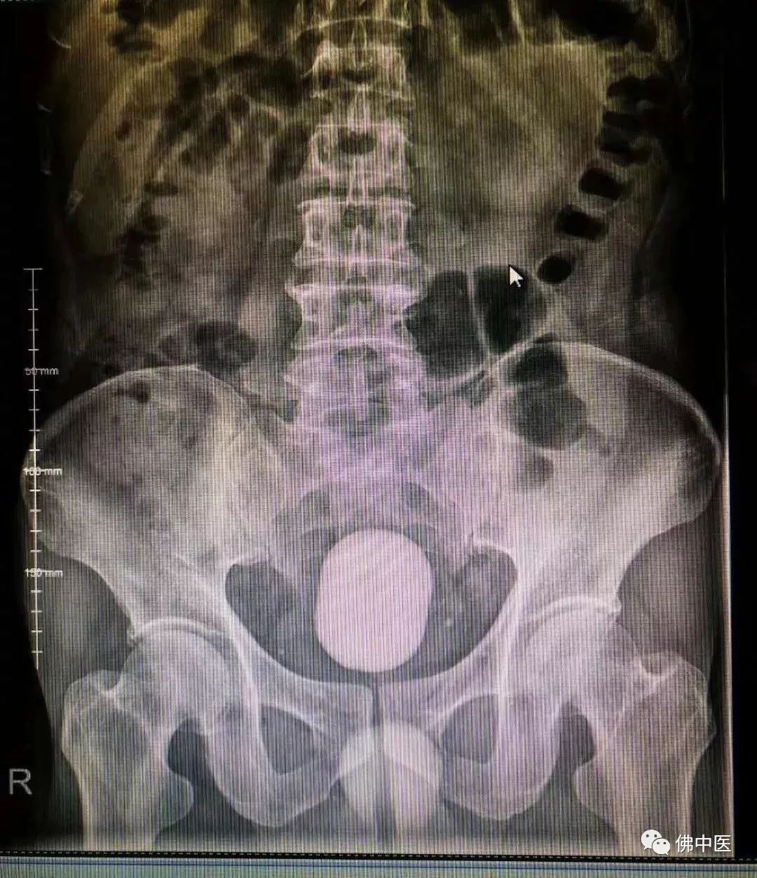 70岁老人前列腺肥大膀胱结石,膀胱巨大结石的症状