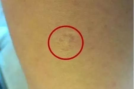 胳膊上的疤痕是怎样形成的,手臂上哪里的疤不容易被发现
