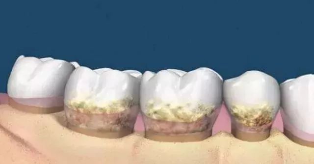 牙黄口臭用什么牙膏最有效贴吧,去牙黄口臭的牙膏最有效