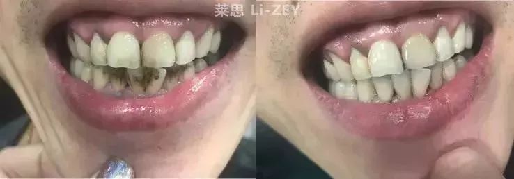 牙黄口臭最好的药,牙黄口臭用什么神器好