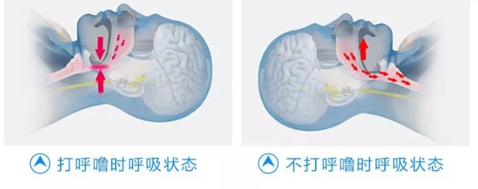 打呼噜其实是一种病,打呼噜是一种病吗有药可治吗
