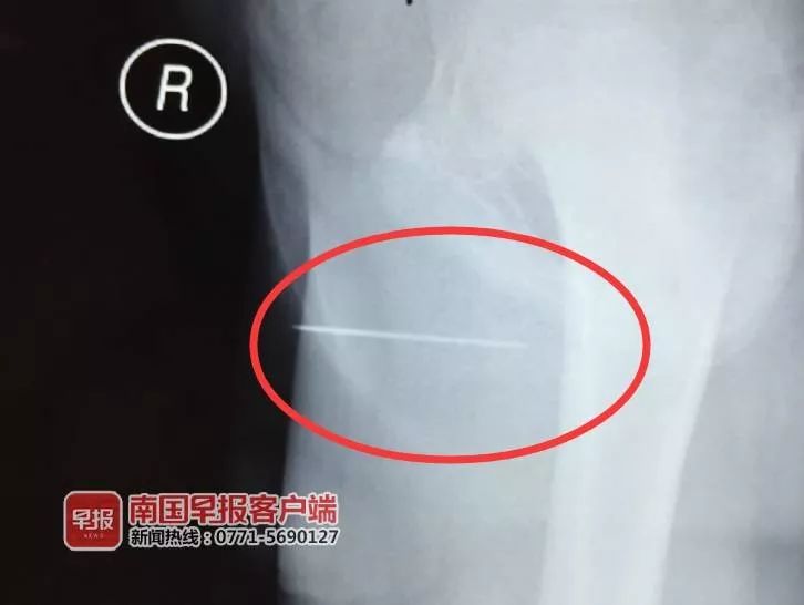 吓人！11岁男孩在家中玩耍，竟将一根4.5厘米长缝衣针塞入*体下**