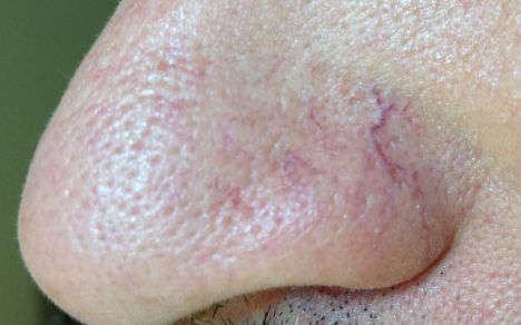 脸上的红血丝怎么处理,脸上的红血丝怎么解决