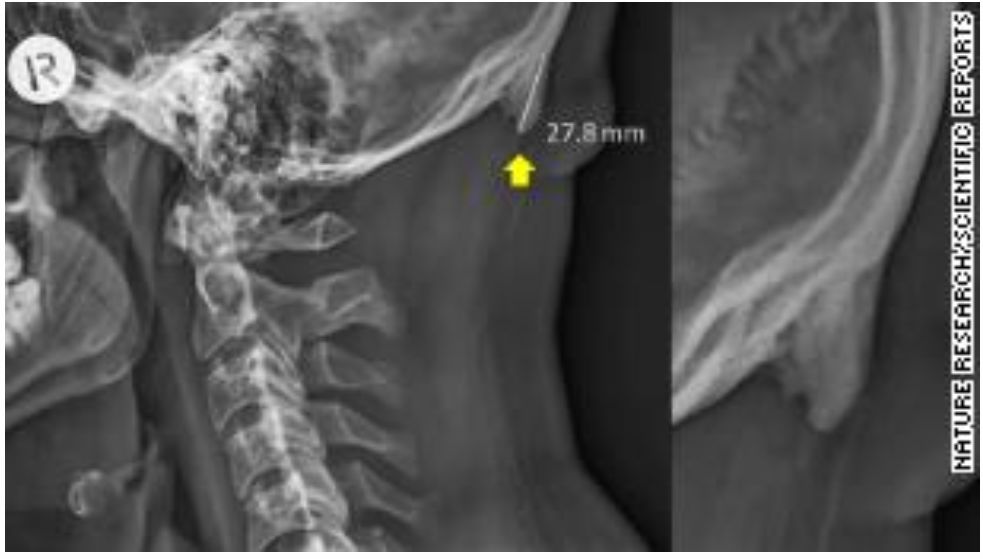 玩手机改变骨盆前倾,玩手机改变面貌有多大