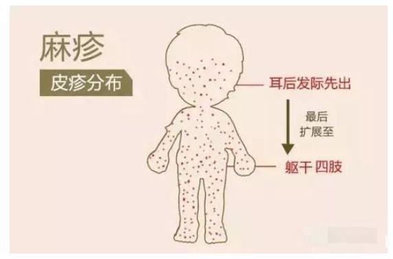 夏季手足口病的预防小知识,手足口水痘注意事项