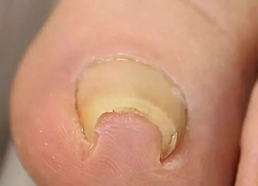 剪指甲错层,指甲该怎么剪才是正确的