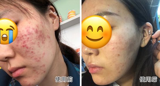 断货王祛痘胶囊,秒杀祛痘化妆品一元