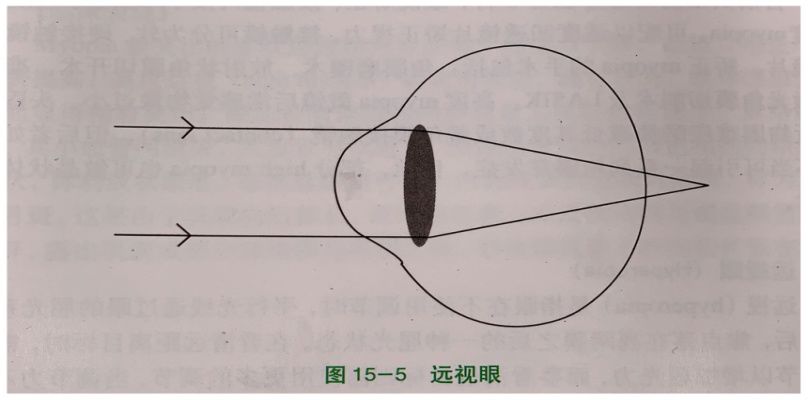 医生说孩子眼球不正常,医生诊断屈光不正是什么意思