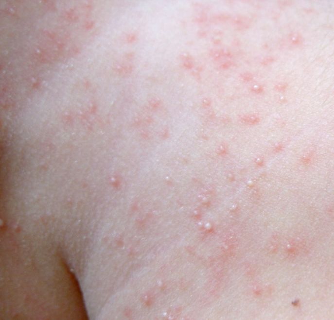 治疗痱子的8个妙招,有关治痱子的小妙招