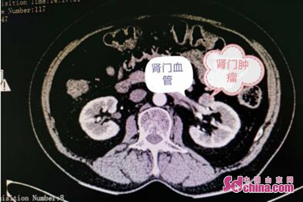 零缺血免缝合烟台滨医附院腹腔镜手术保住患者肾脏