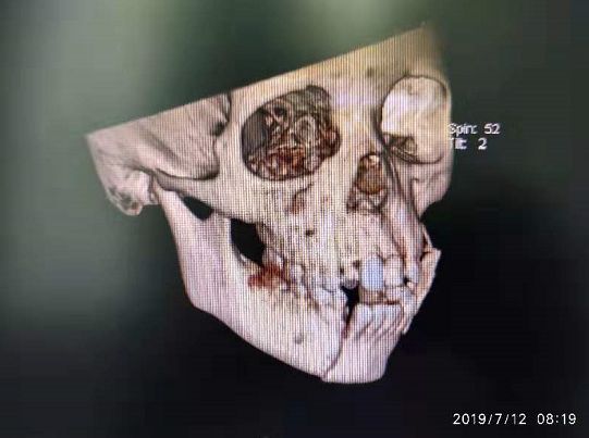 四川小孩被玩伴嘴角撕裂,男童嘴角裂到耳根