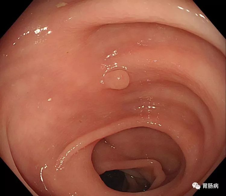 消化息肉科普视频,结直肠息肉癌变的规律