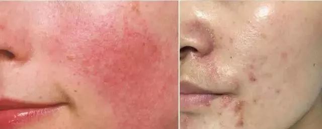 柔嫩抛光|脸上搓出3斤泥!难怪又黄又暗又黑头!10秒给脸蛋“剥壳”,厉害