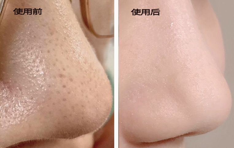 脸上搓出3斤泥！难怪又黄又暗又黑头！10秒给脸蛋“剥壳”，厉害