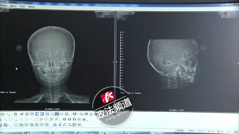 男孩体温计打破水银中毒,四岁男孩把水银体温计插在眼睛里