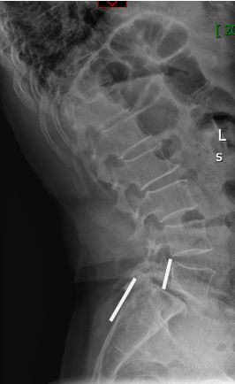 腰椎滑脱怎样做有氧康复训练,腰椎滑脱康复治疗预后