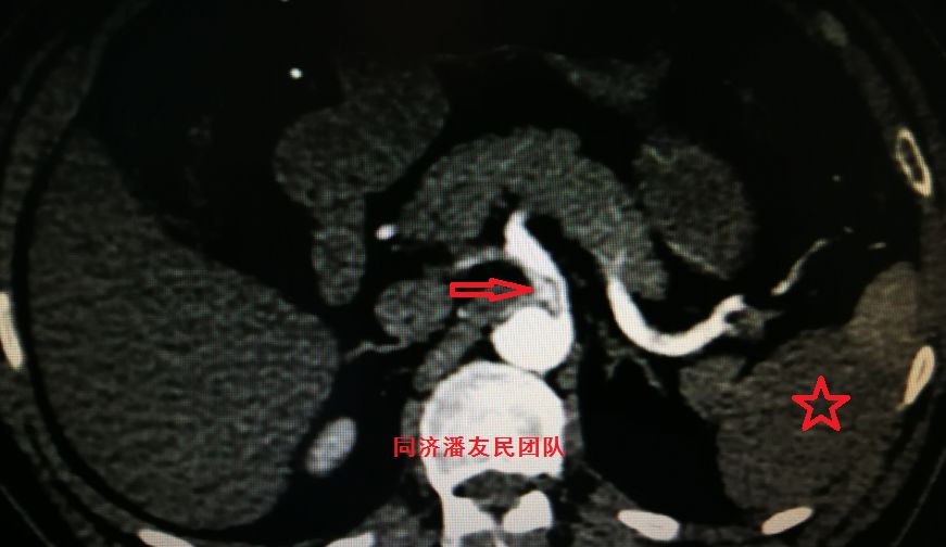 诊断主动脉夹层最简单有效的方法,心脏主动脉夹层是什么原因造成的