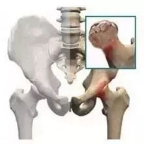 股骨头坏死保髋手术能撑几年,股骨头坏死的保髋治疗