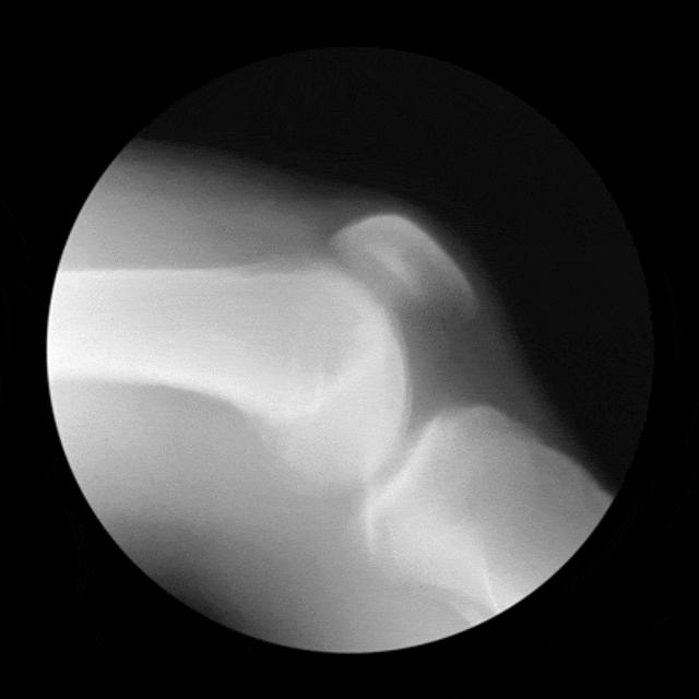 膝盖损伤有多痛,膝盖痛自愈方法靠谱吗