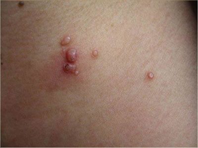 关于传染性软疣的防治,传染性软疣严重吗吓人吗