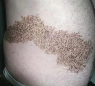 雀斑样痣和雀斑的区别有哪些,雀斑和青褐色痣