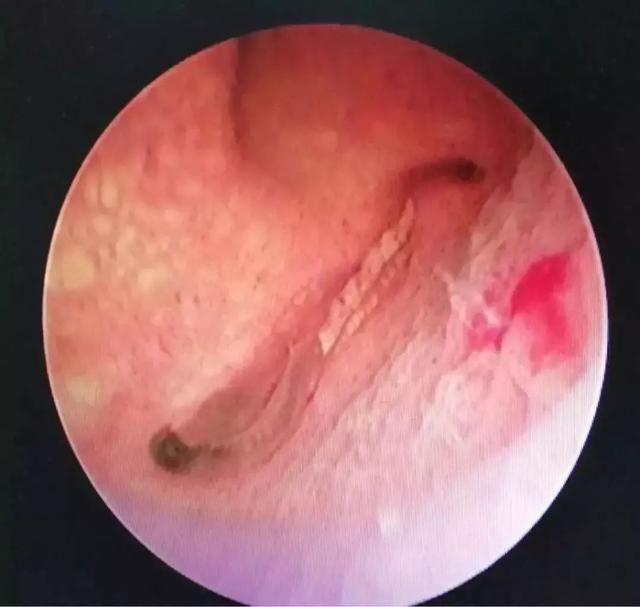 男子体内排出一条活虫,男子体内排出活虫只因爱吃一道菜