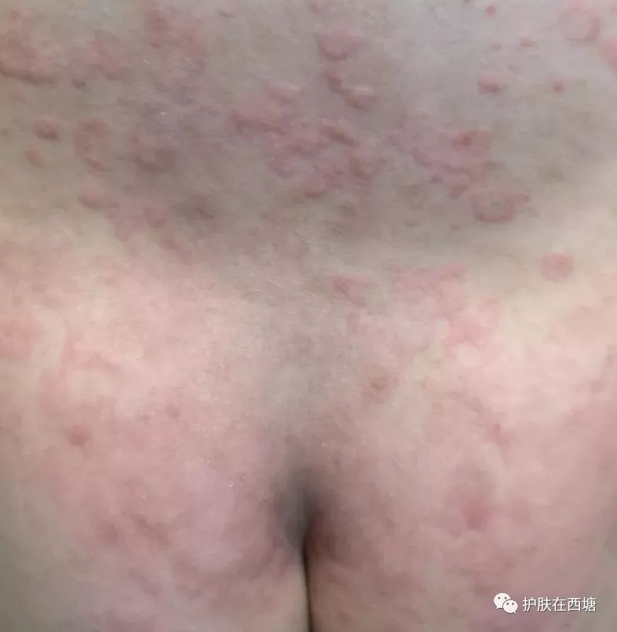 水过敏会引起荨麻疹吗,水过敏皮肤