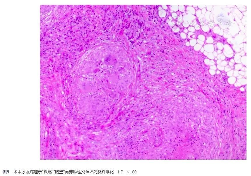 胸腺鳞癌临床出现的几率是多少,胸腺鳞癌一期高分化能活十年吗