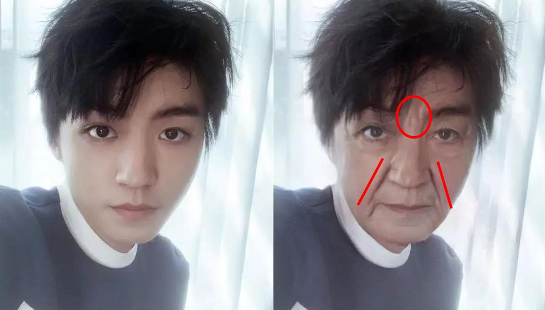 消除眉间法令纹最有效的方法,眉间纹和法令纹医美