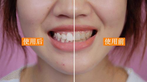 牙龈肿了出血口臭牙黄用什么牙膏,牙龈上火牙膏