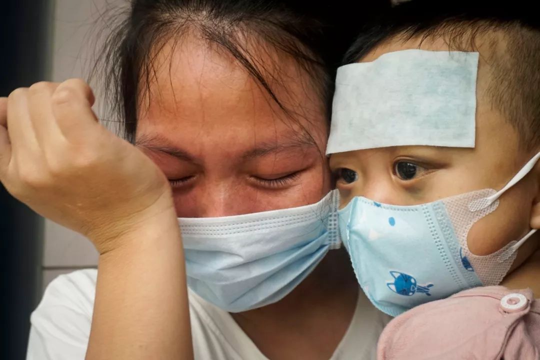 小男孩双眼淤青肿胀，酷似熊猫眼，父母曾被人怀疑虐待孩子