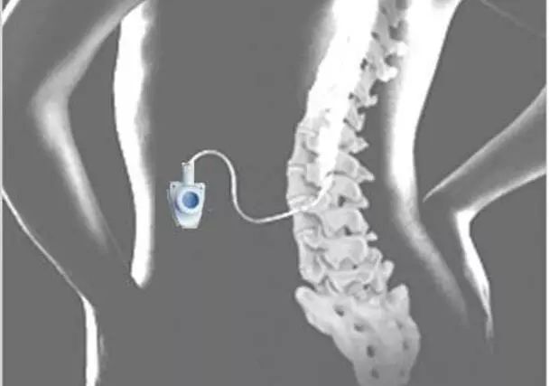 顽固性癌痛怎么止痛,用什么方法治疗癌性疼痛