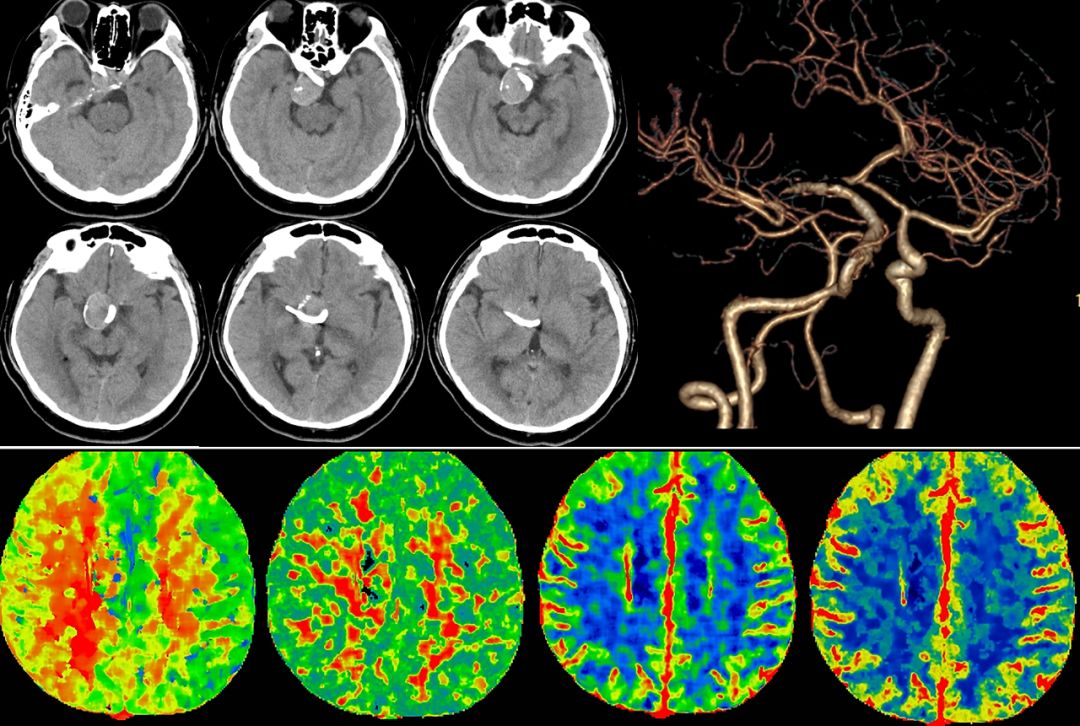 物华天宝·第7期｜脑部长型巨大夹层动脉瘤的4个密网支架桥接治疗复查治愈（附复查CTA结果）