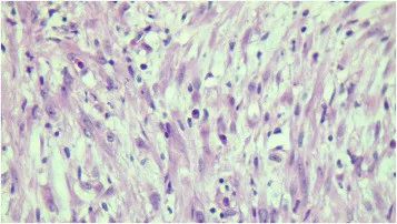 膀胱低级别肌纤维母细胞增生,膀胱纤维母细胞瘤