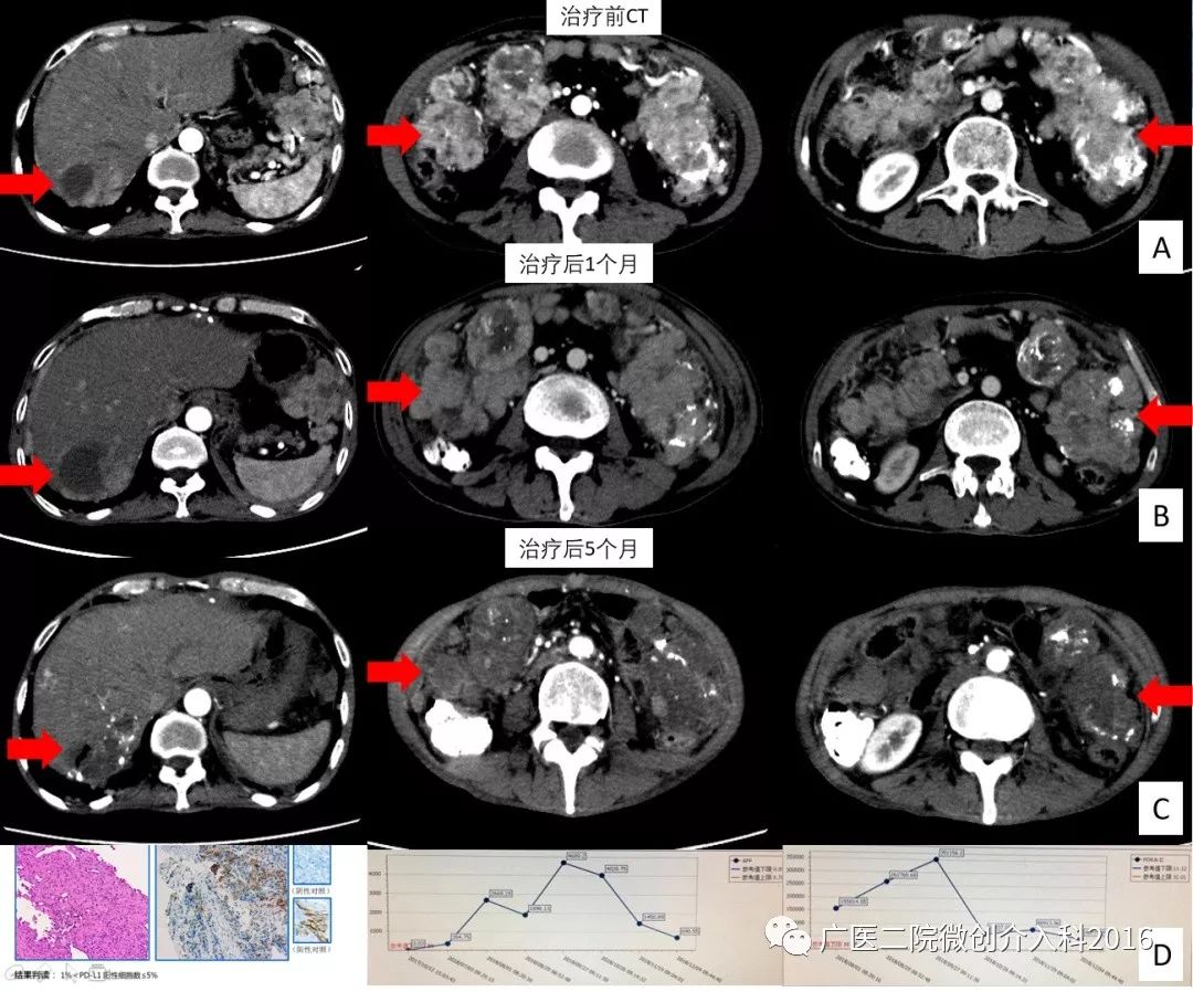 精准介入治疗效果好吗,精准免疫治疗最新消息