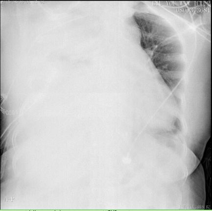肺癌介入栓塞术后并发症,肺癌术后肺栓塞的病历模板