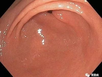 胃肠镜是不是胃镜和肠镜一起检查,胃肠镜是包括胃镜和肠镜吗